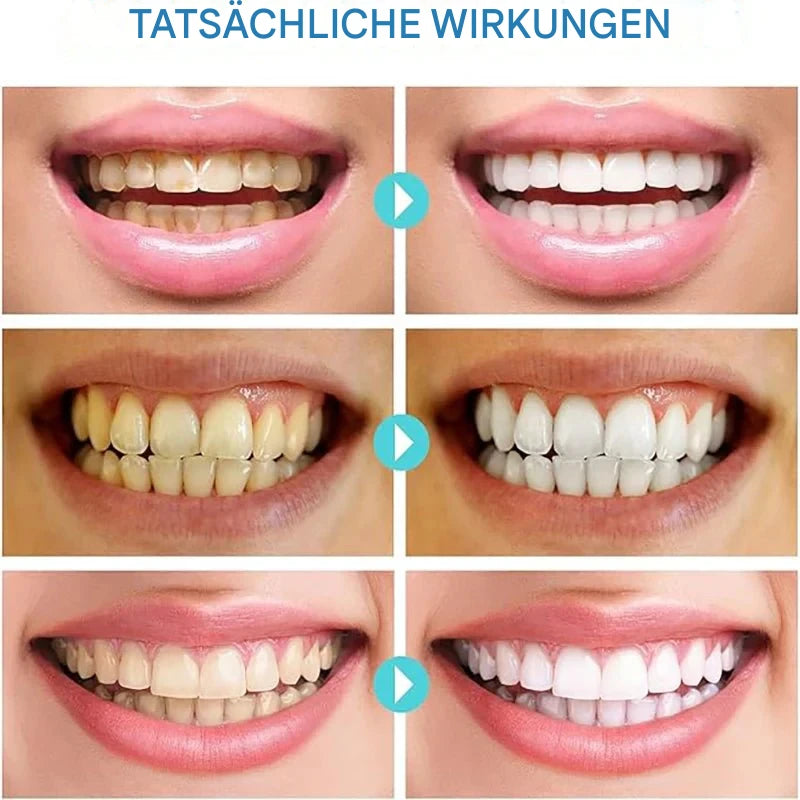 PureTeeth™ - Immediate Whitening