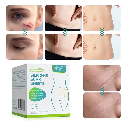 Medical Soft Silicone Gel Tape Designed for Scar Removal