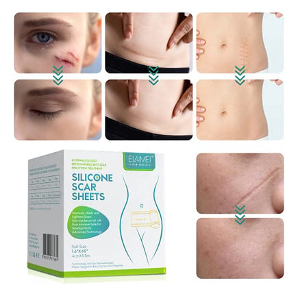 Medical Soft Silicone Gel Tape Designed for Scar Removal