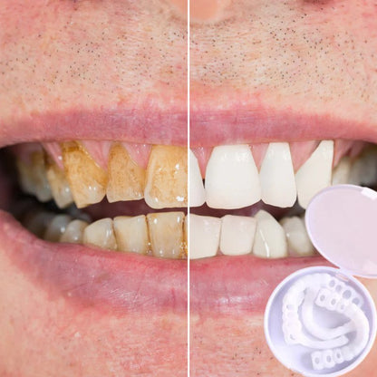 Snap-on Smile™ — Effortless Flawless Confidence | 50% Off