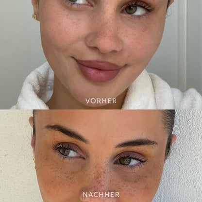 FrecklEase™ — Unlock Your Effortless, Sun-Kissed Confidence Instantly