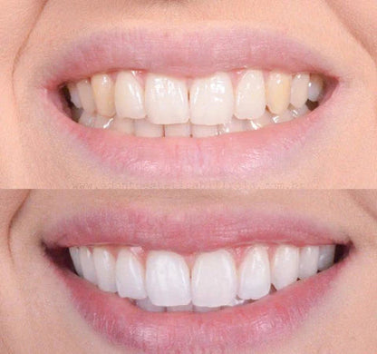 GlacialWhite™ — Unleash a Radiant Smile That Turns Heads Instantly