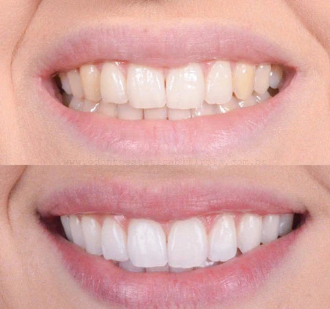 RadianceBurst™ — Transform Your Smile Instantly Without Sensitivity or Chemicals