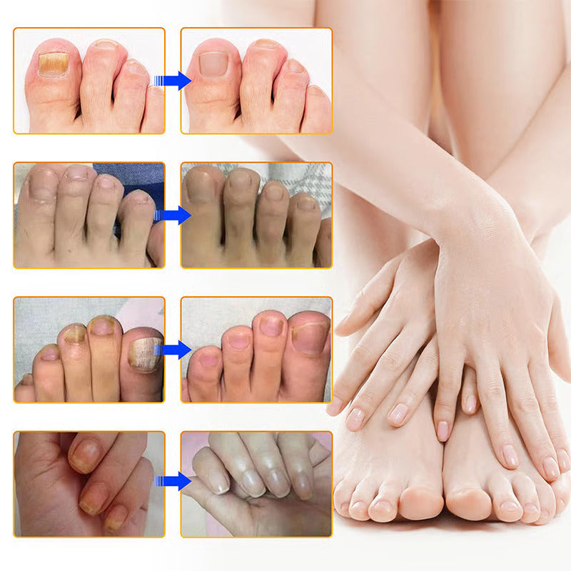 ClearCure™ Nail Patches — Restore Gorgeous, Confident Nails Without the Embarrassment